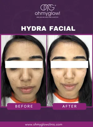 Before and after Hydra Facial treatment at Oh My Glow Clinic, Chandigarh