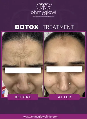 Before and after Botox treatment at Oh My Glow Clinic, Chandigarh